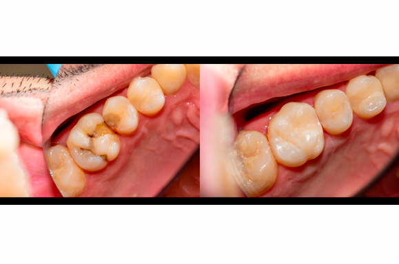 Restaurações Estéticas Odontológicas - Curitiba - PR