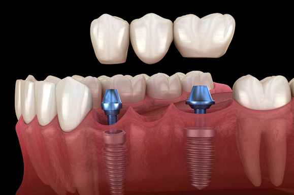 Clínica de Implantes Dentários - Curitiba - PR