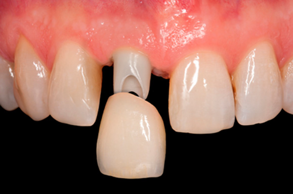 Clínica de Implantes Dentários - Curitiba - PR