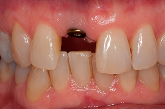 Clínica de Implantes Dentários - Curitiba - PR