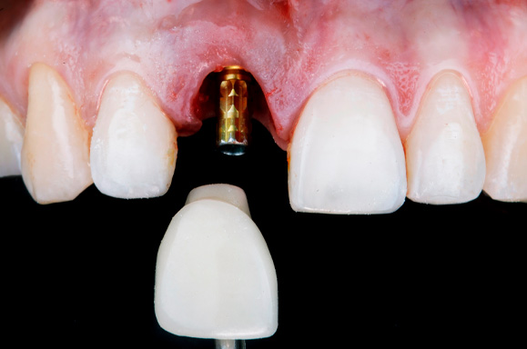 Clínica de Próteses Dentárias Curitiba - PR