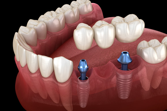 Clínica de Próteses Dentárias Curitiba - PR